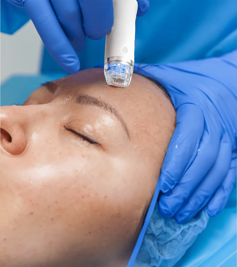 Radiofrecuencia Microneedling Morpheus 8 -Toni5SalonSpa