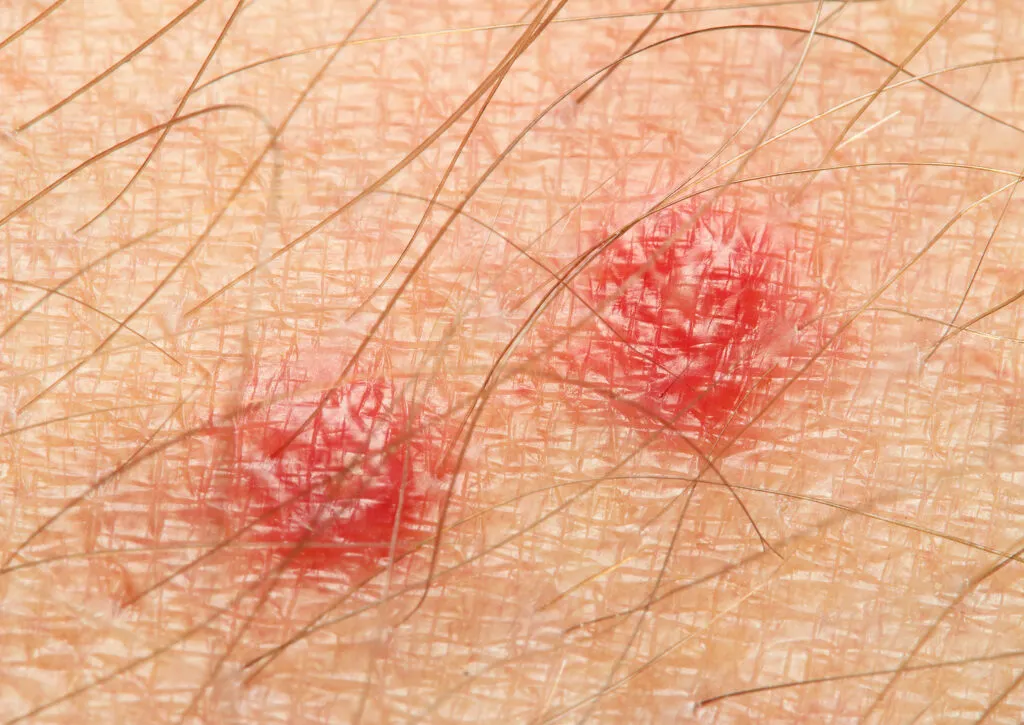 What does bed bites look like?