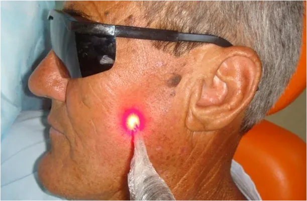 tratamento neuralgia trigemeo