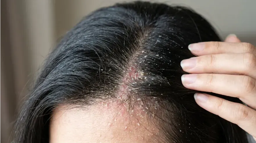 Close-up of a scalp with visible flaking or dandruff to illustrate scalp imbalance and showing signs of an unhealthy scalp.