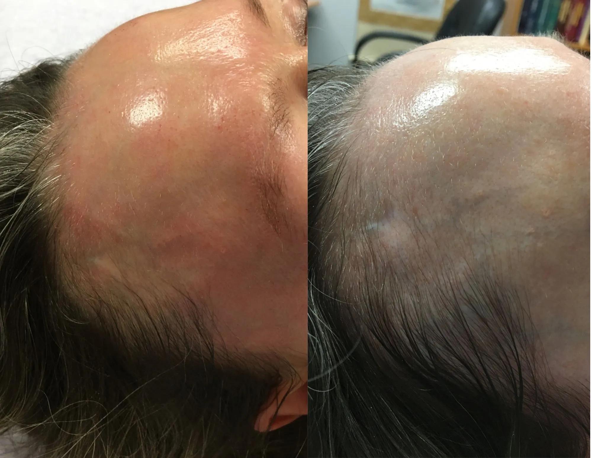 microneedling for hair restoration