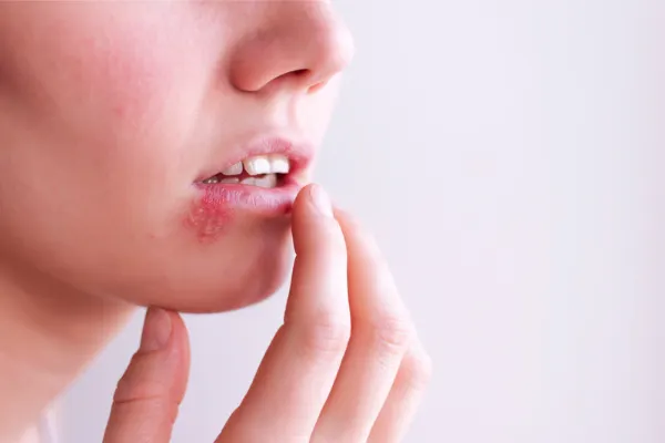 laserterapia aftas herpes