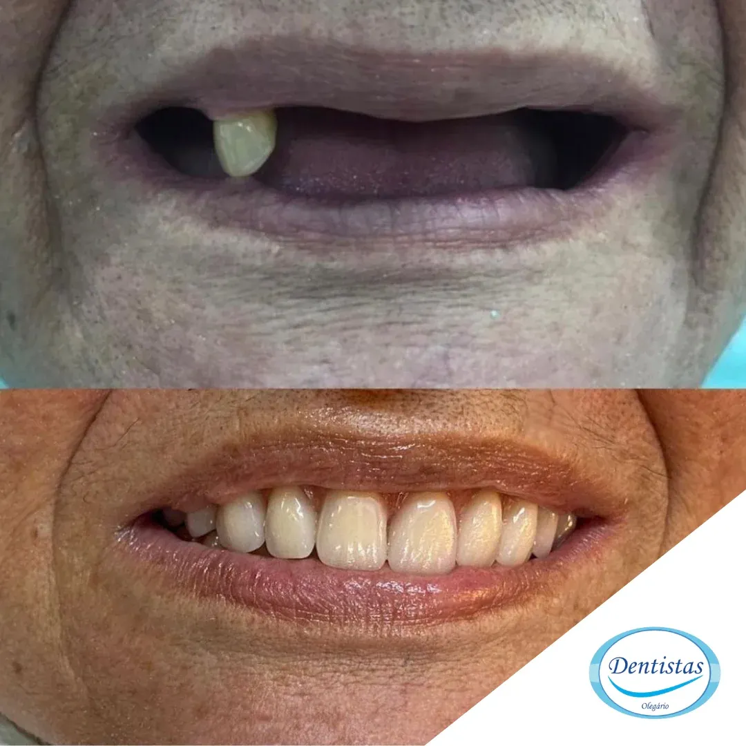implante dentario dentista olegario barra da tijuca rj