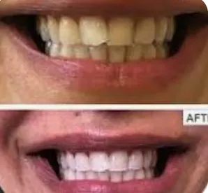 Before and after prodentim