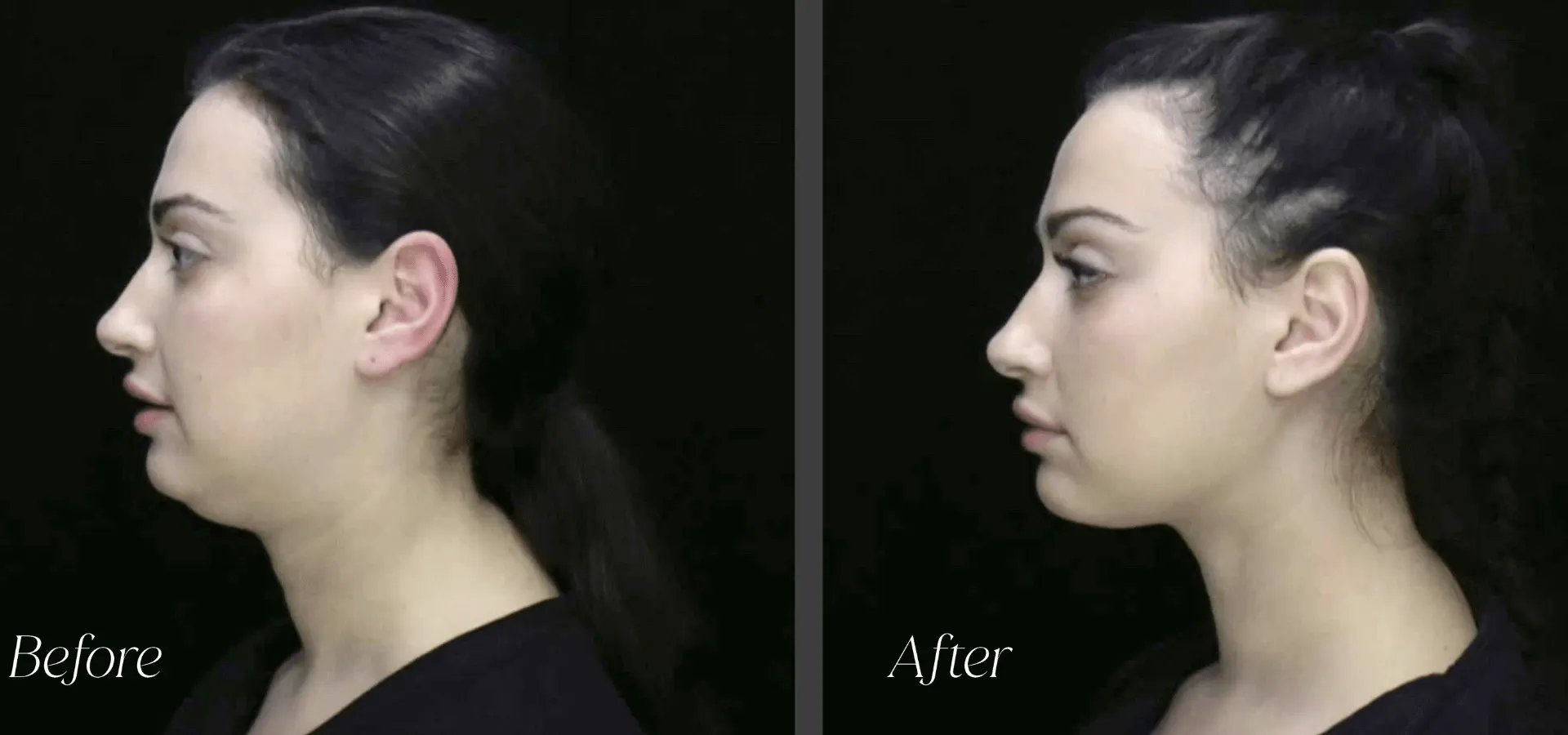 A dramatic before and after of a woman that had the MyEllevate neckline procedure