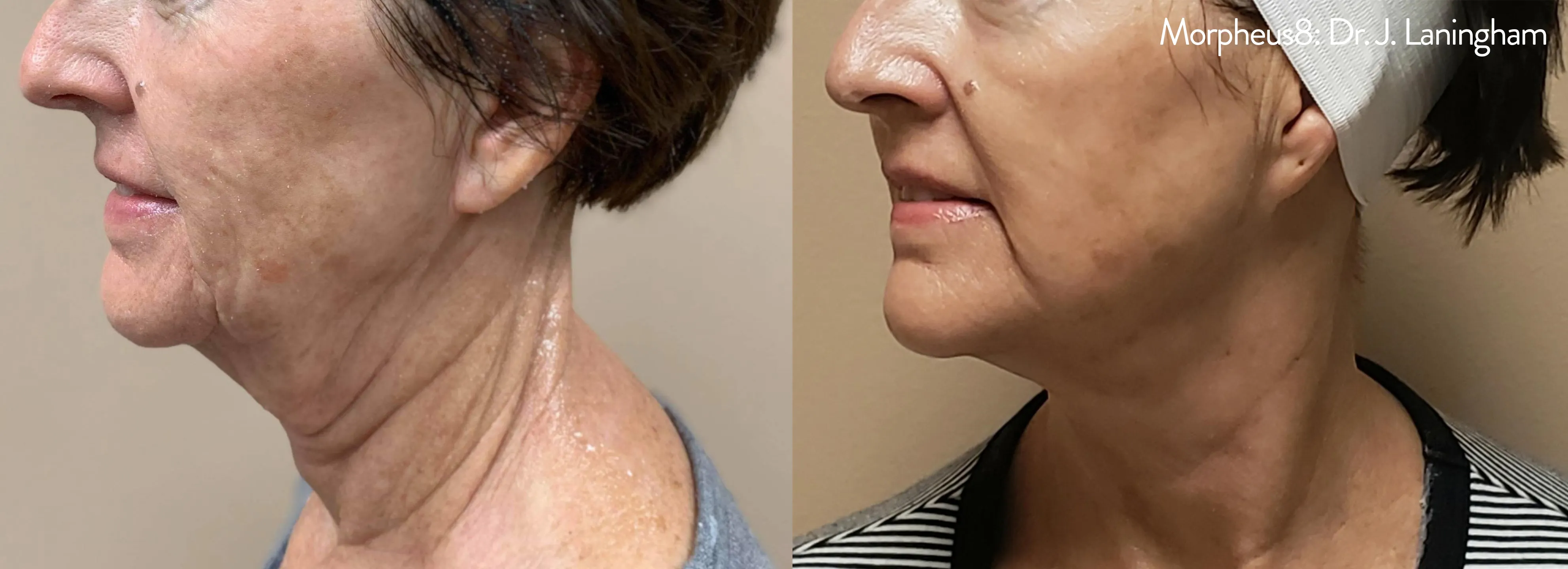 Morpheus8 Before and After