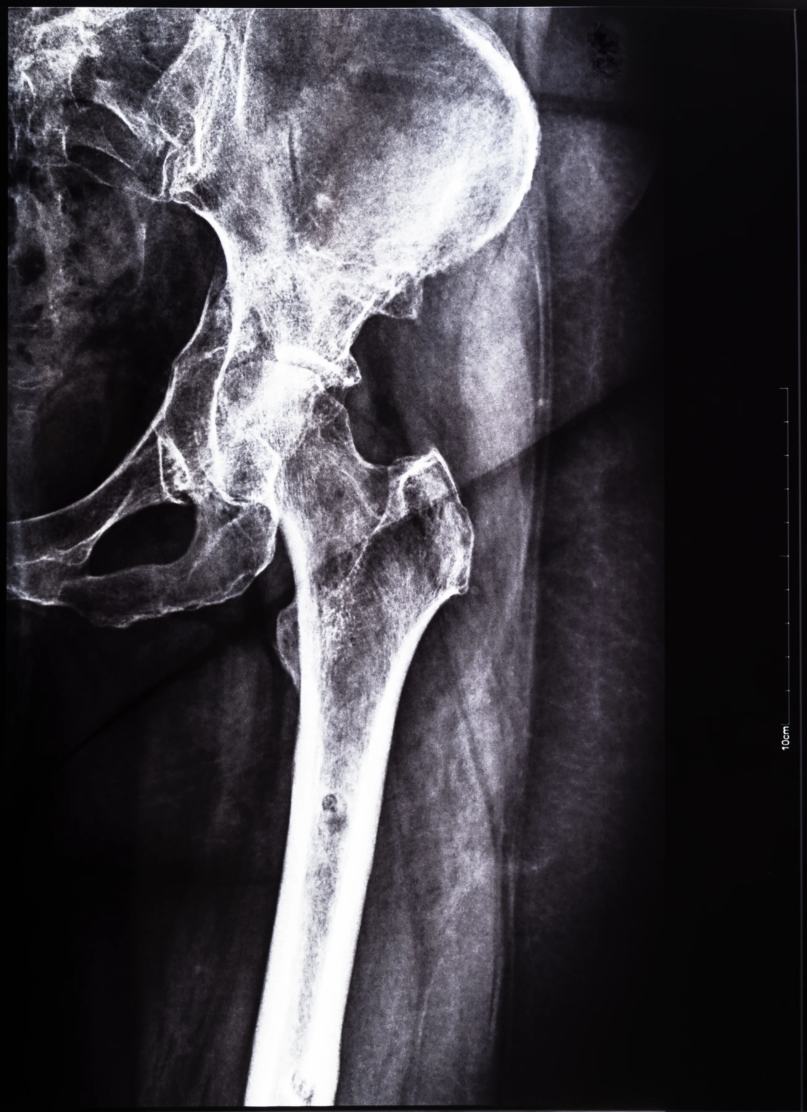 xray of a hip