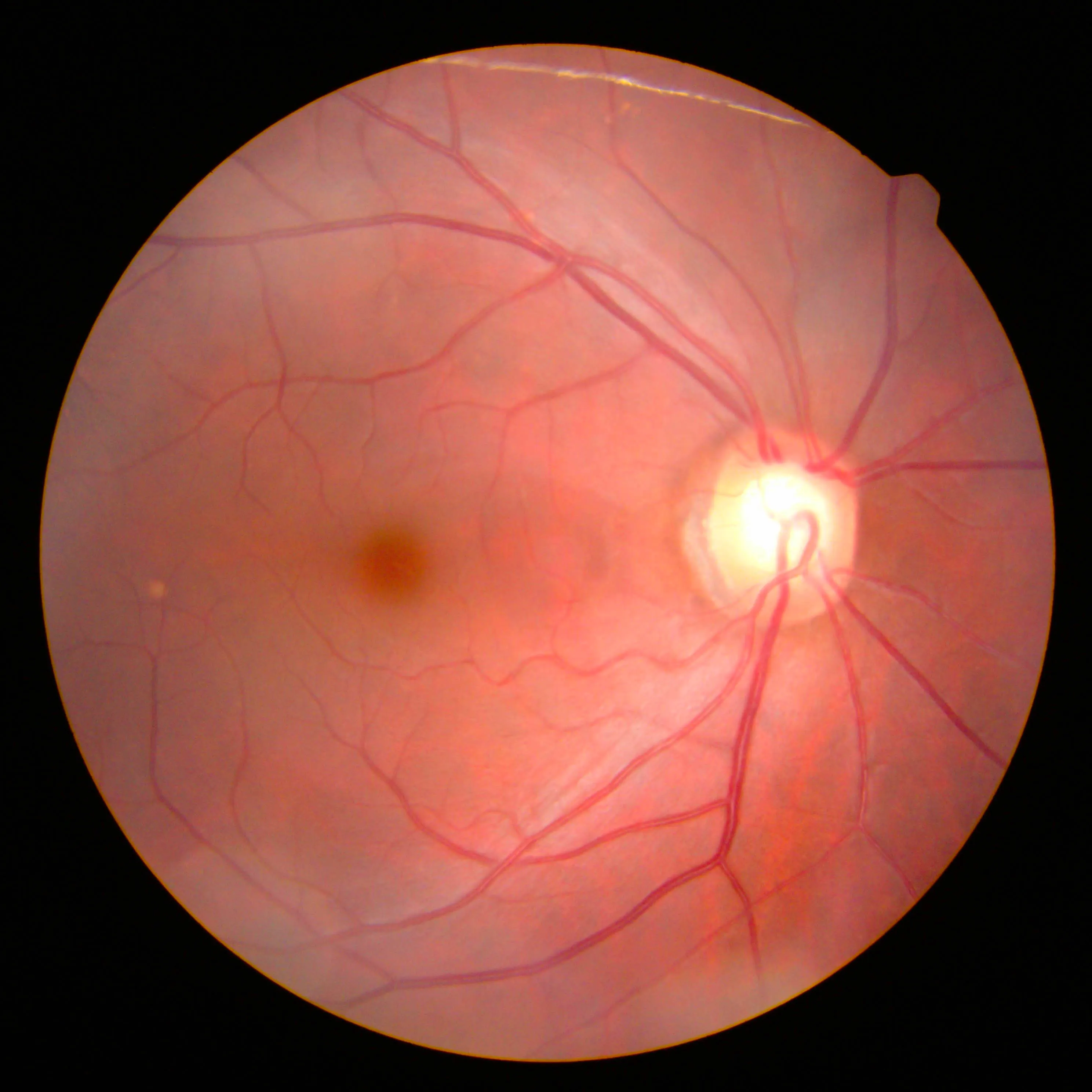 Retina in Glaucoma