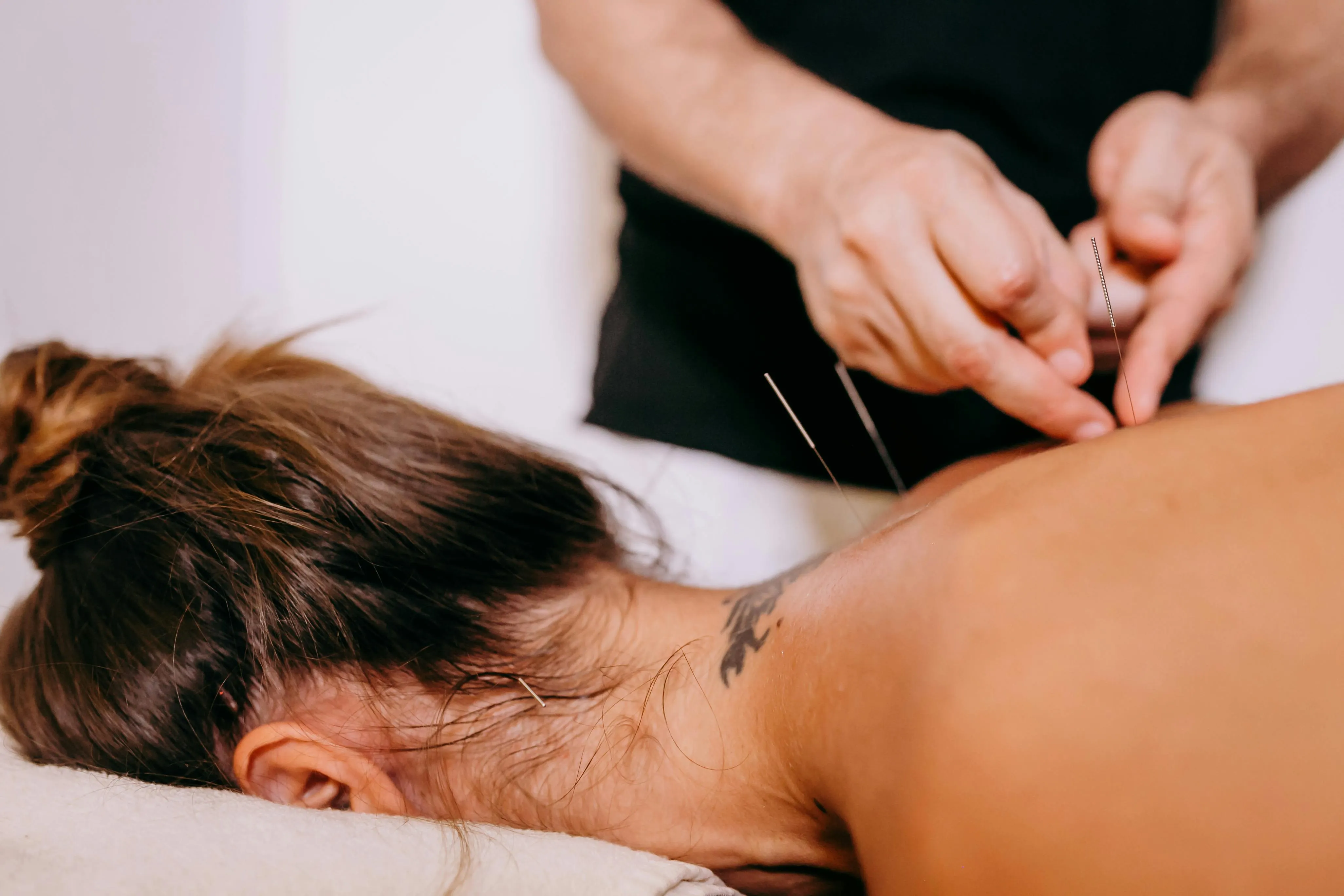 dry needling willetton