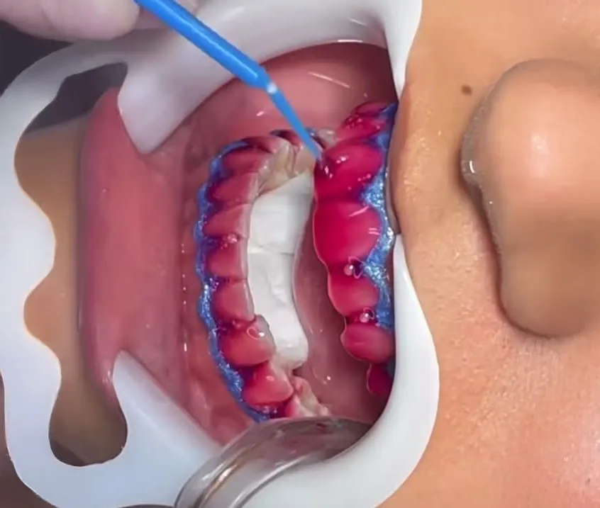 Procedimento de Clareamento