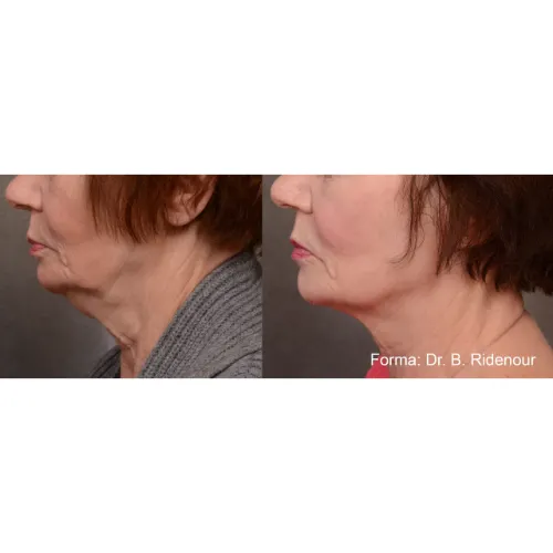 before and after rf skin tightening
