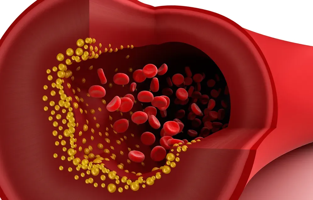 A detailed illustration showing a cross-section of an artery with varying levels of LDL cholesterol buildup.