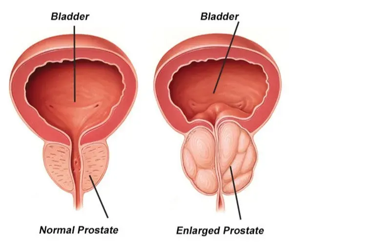 Side by side comparison of normal prostate and enlarged prostate causing urethral narrowing.