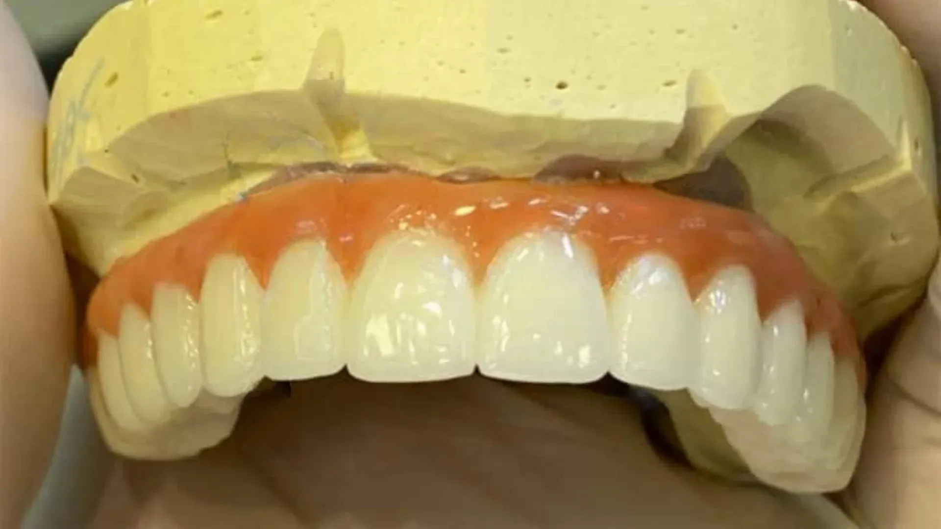 protocolo em zirconia metal free cad cam