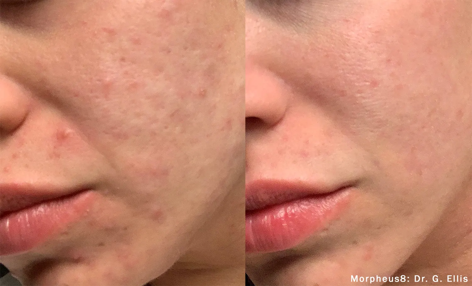 Morpheus8 before and after blemish 