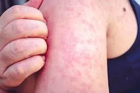 Measles Symptoms and Risks