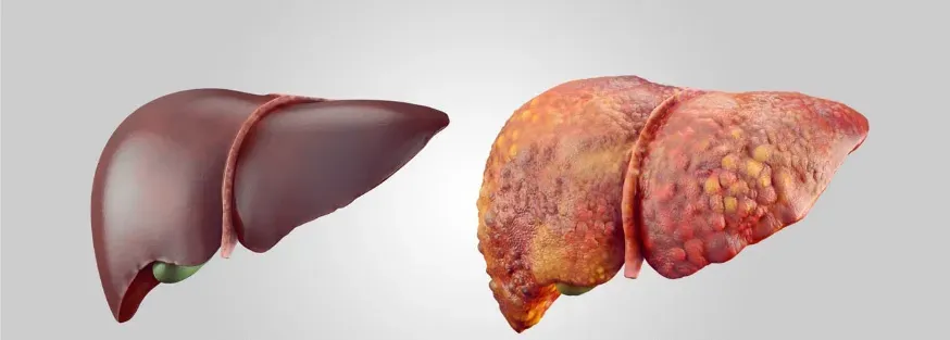 A split-screen image comparing the liver of a healthy individual with the liver of a person suffering from alcohol-induced liver damage