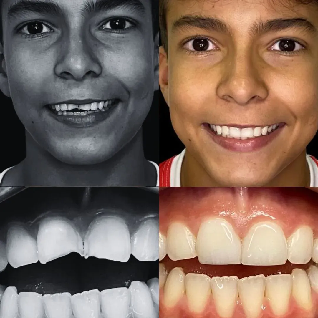 lentes resina rj