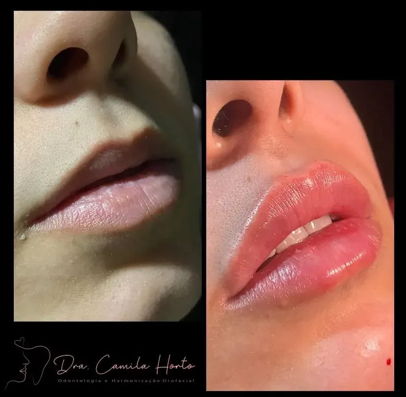 prenchimento labial ramos rj