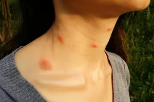 Bed Bug Bites (signs & symptoms)
