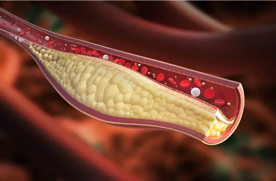 Image of a blocked artery.