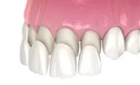 dental veneers queens ny