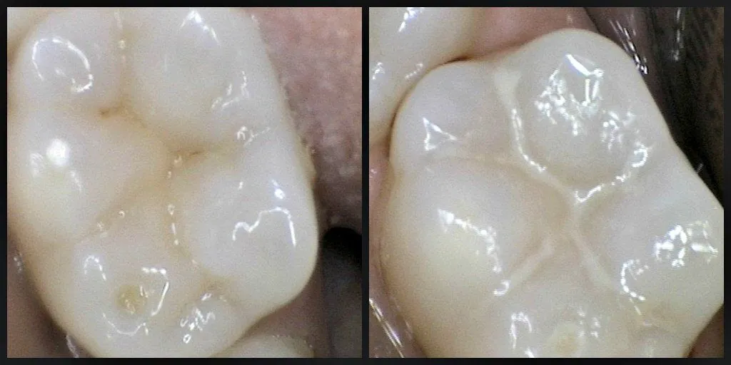dental sealant queens ny