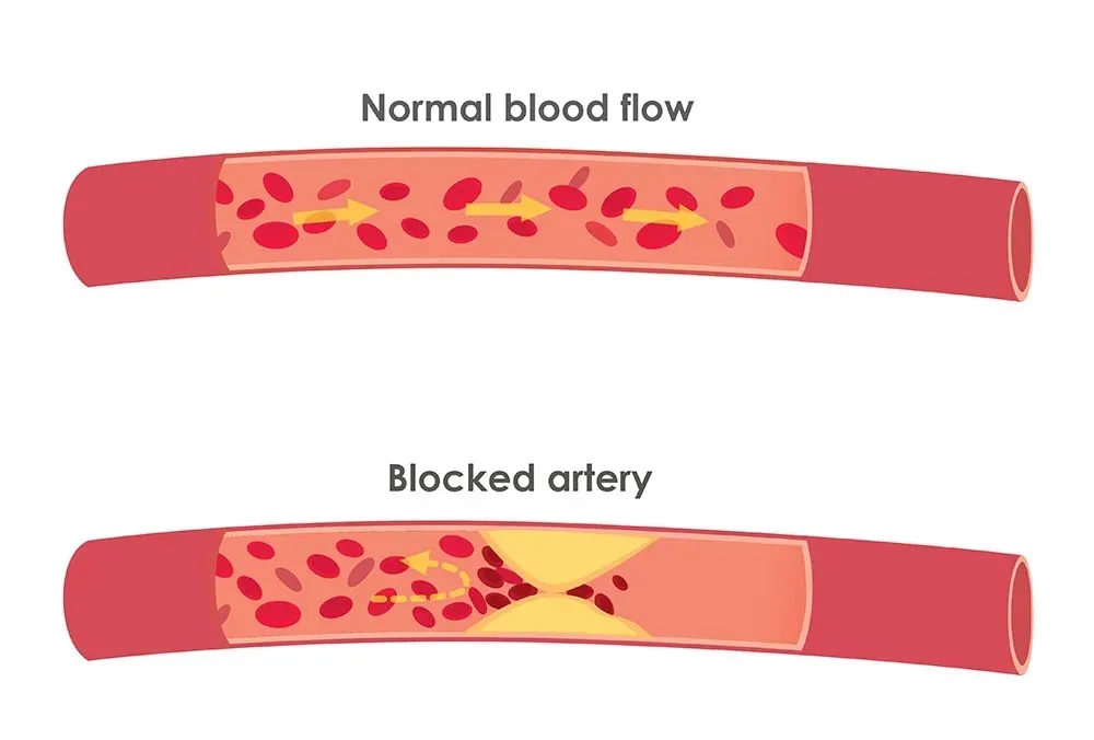 An image of a clear health artery and an unhealthy blocked artery.