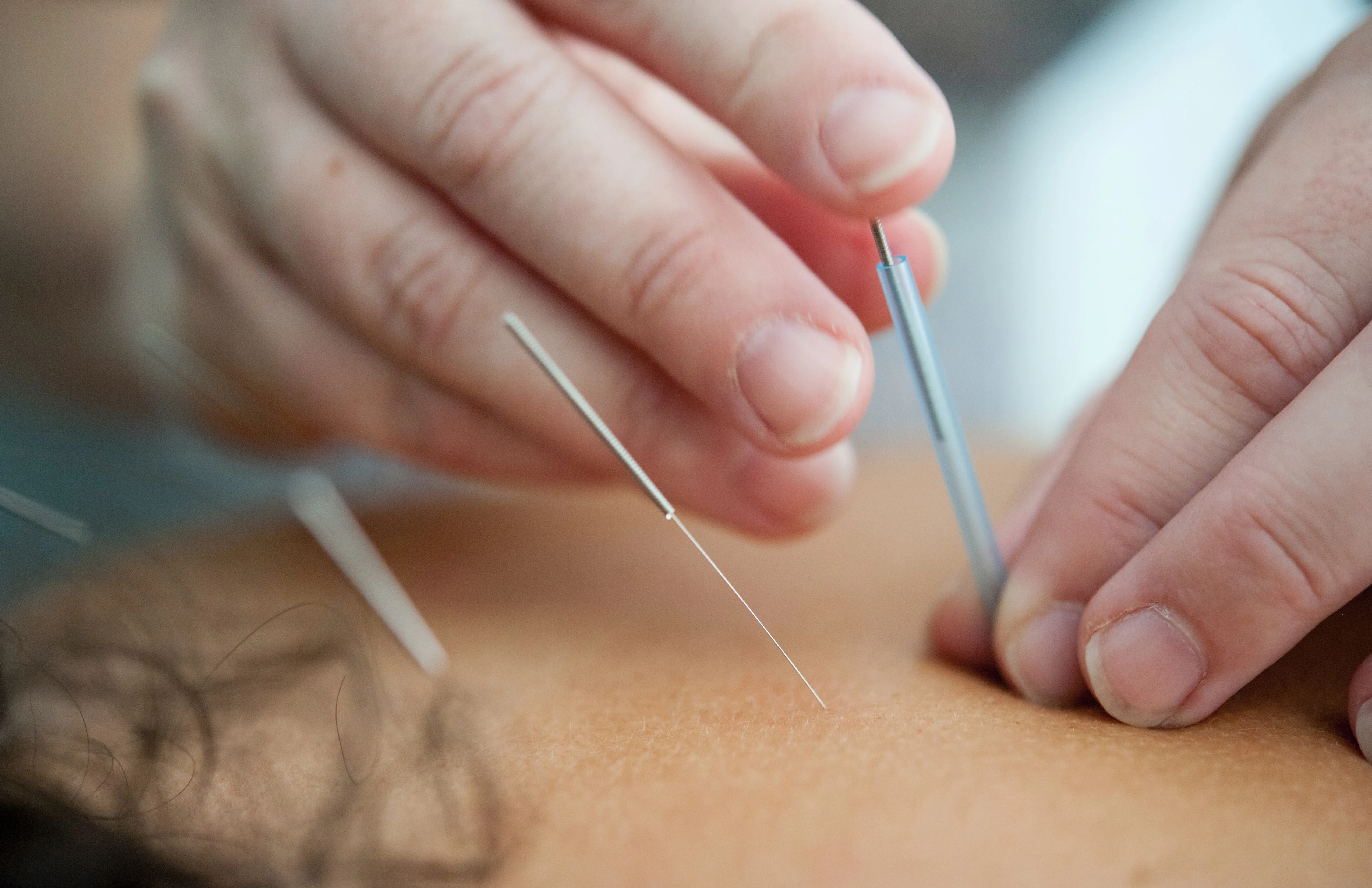 acupuncture pins in someones back