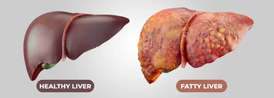 a healthy liver next to an unhealthy fatty liver.