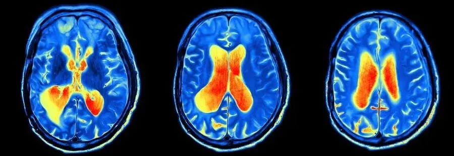 A visual representation of the human brain with highlighted areas that are affected by depression.