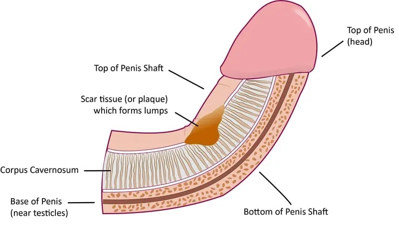 how to fix the curvature in your penis