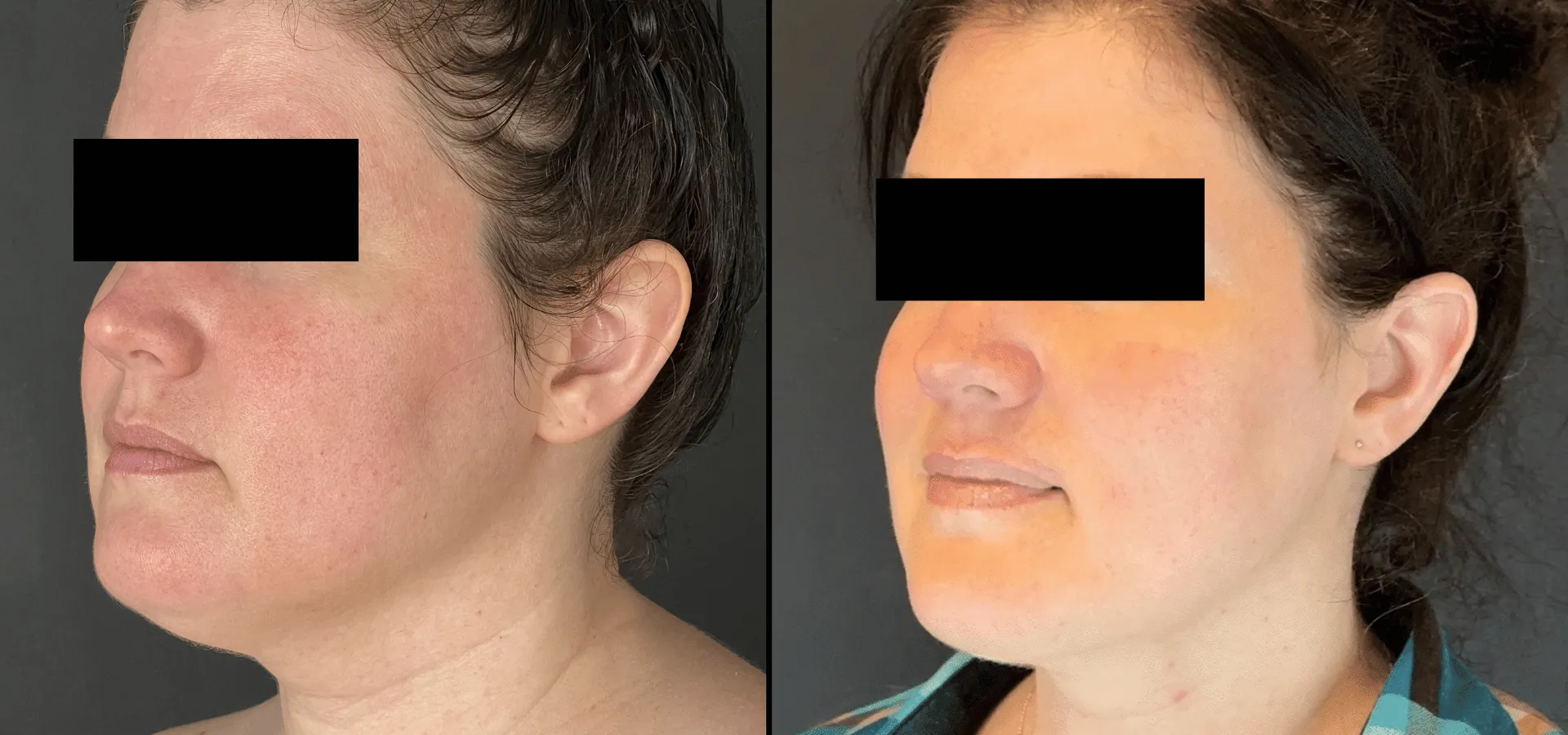 A before and after image of a woman showing the difference in her jawline after Smartlipo