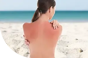 Sunburn Pain