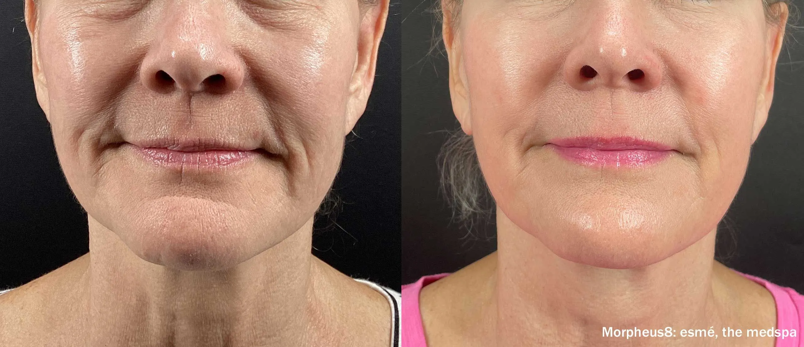 Morpheus8 before and after lauagh lines 