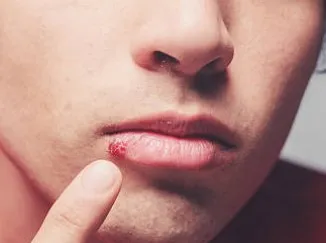 Cold sore can be painful and irritating.