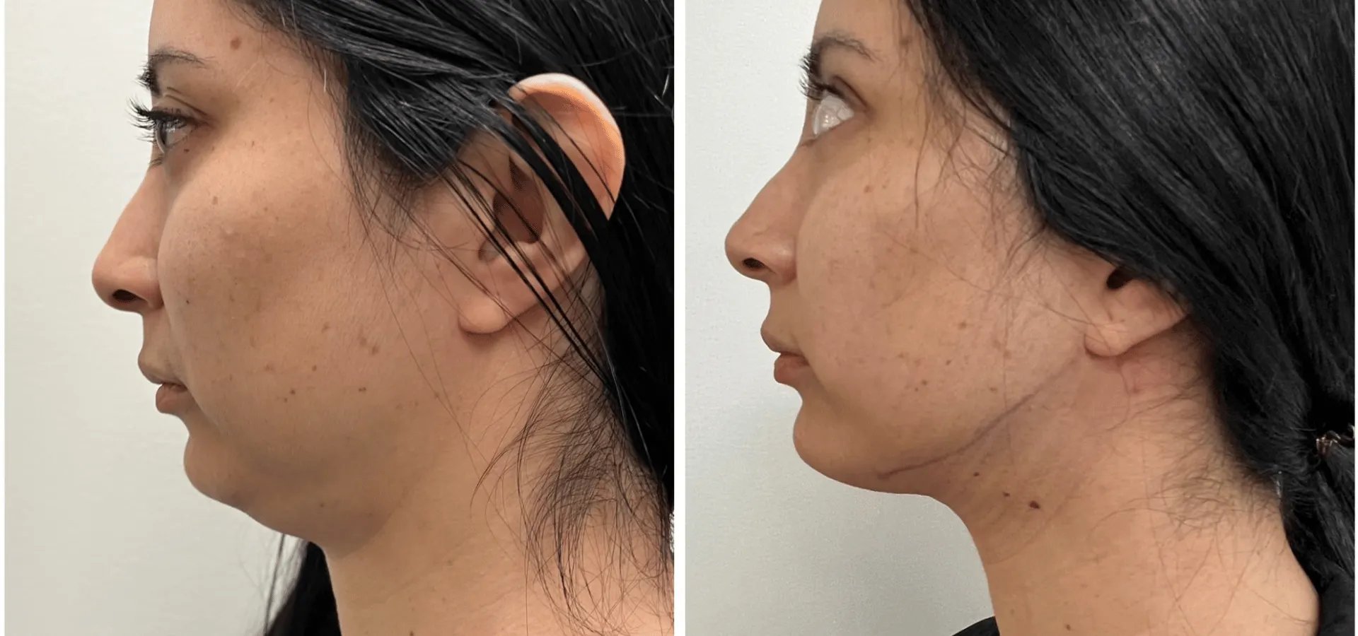 A before and after image of a woman showing the difference in her jawline