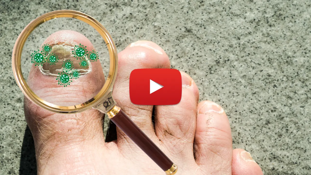 Magnifying Glass view of Toes with fungus spores