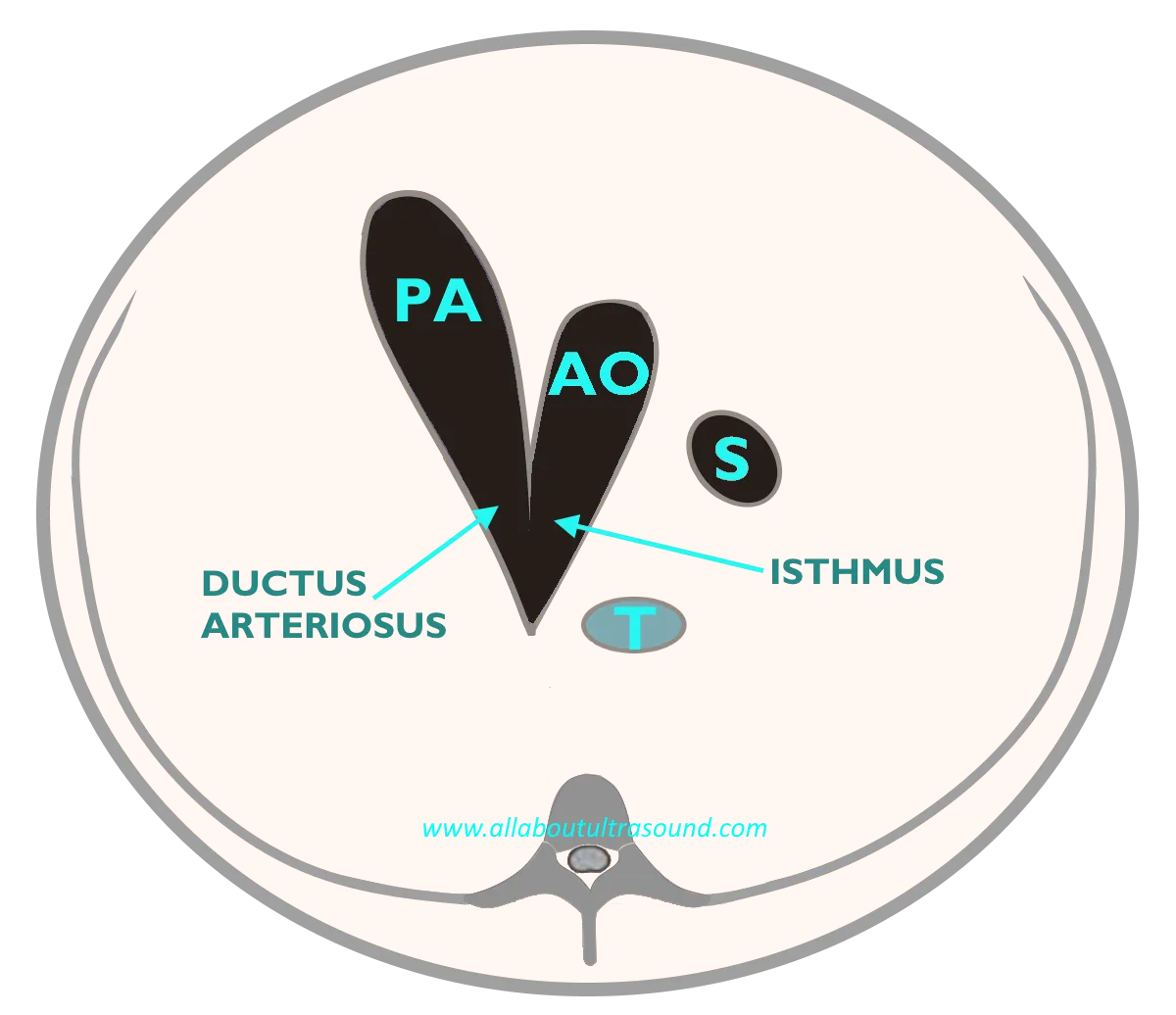 3 vessel trachea view