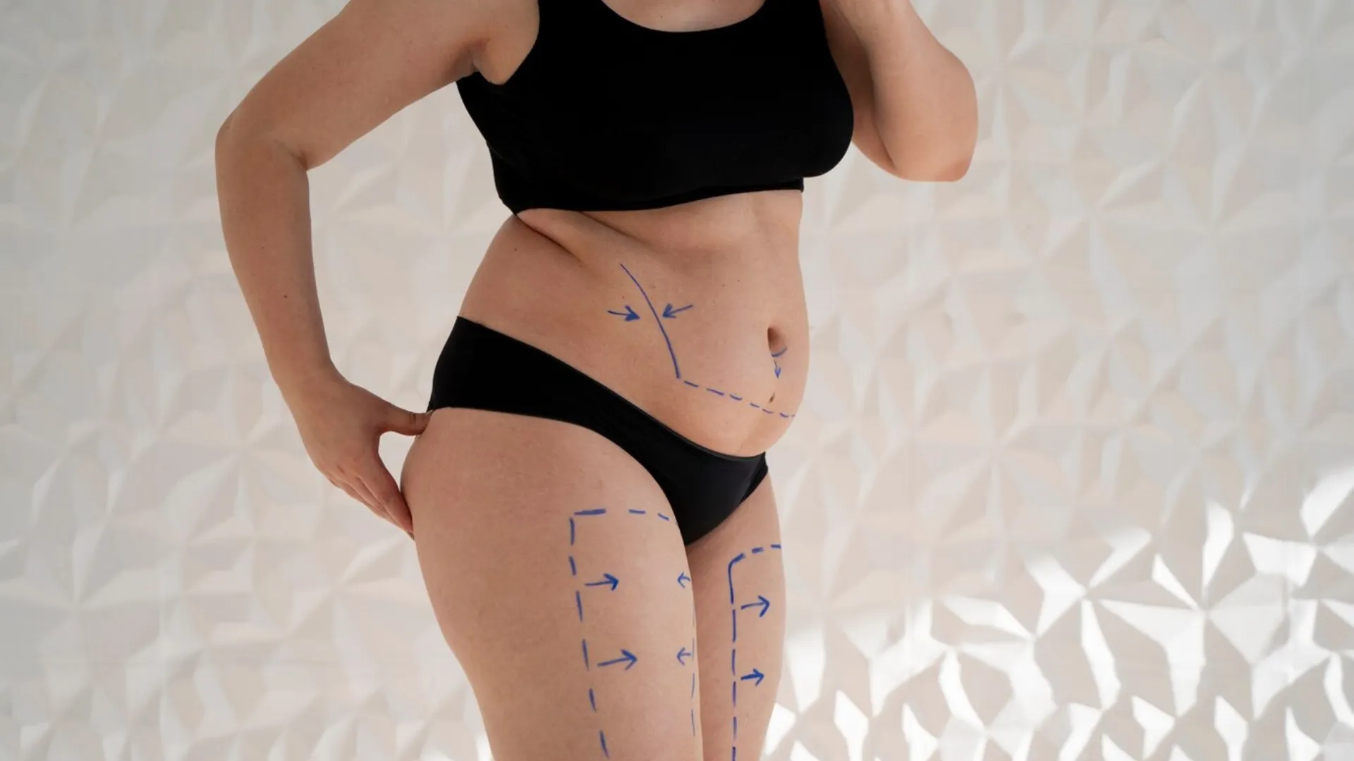 Liposuction 