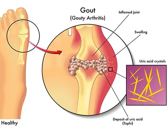 Uric Acid pain, Gout