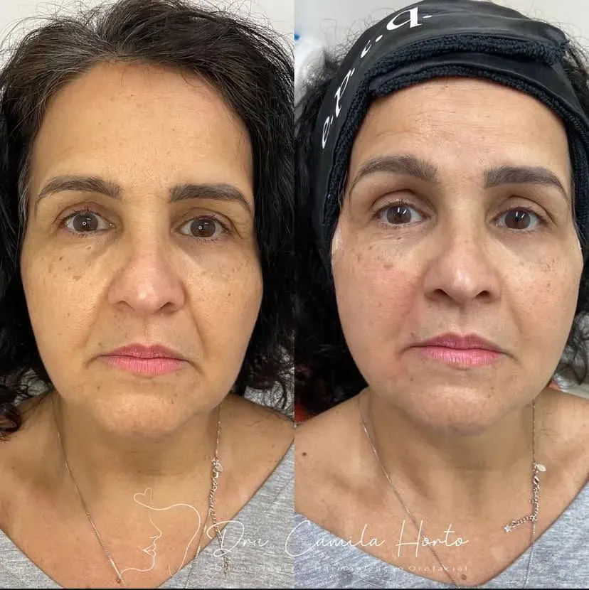 preenchimento facial ramos rj