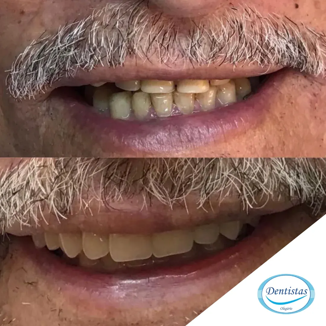 protese fixa protocolo dentista olegario barra da tijuca rj