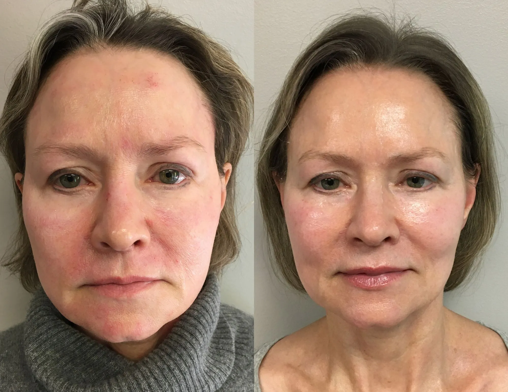 Microneedling before & after 3