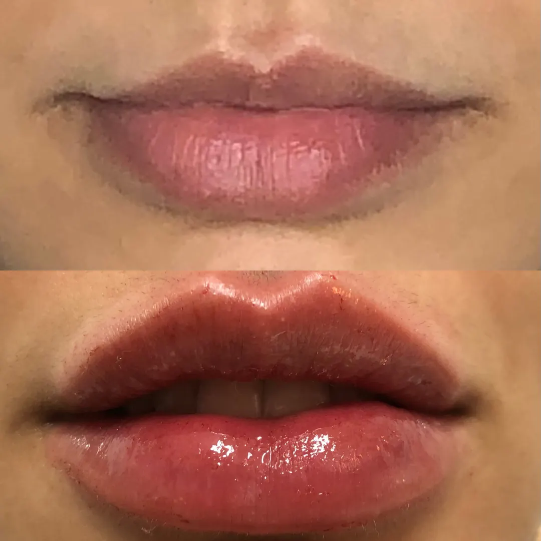 preenchimento labial centro niteroi rj