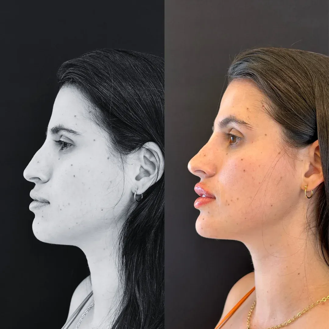 perfiloplastia rj