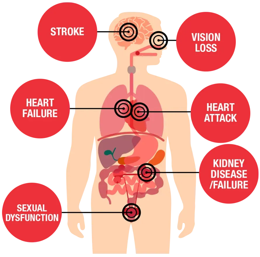 An infographic displaying the heart, arteries, and organs affected by hypertension, like the brain (stroke), kidneys, and eyes.