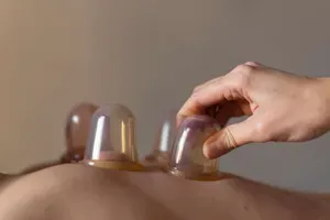 cupping for remedial massage