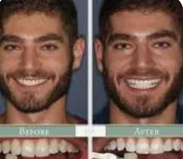 Before and after Prodentim use.