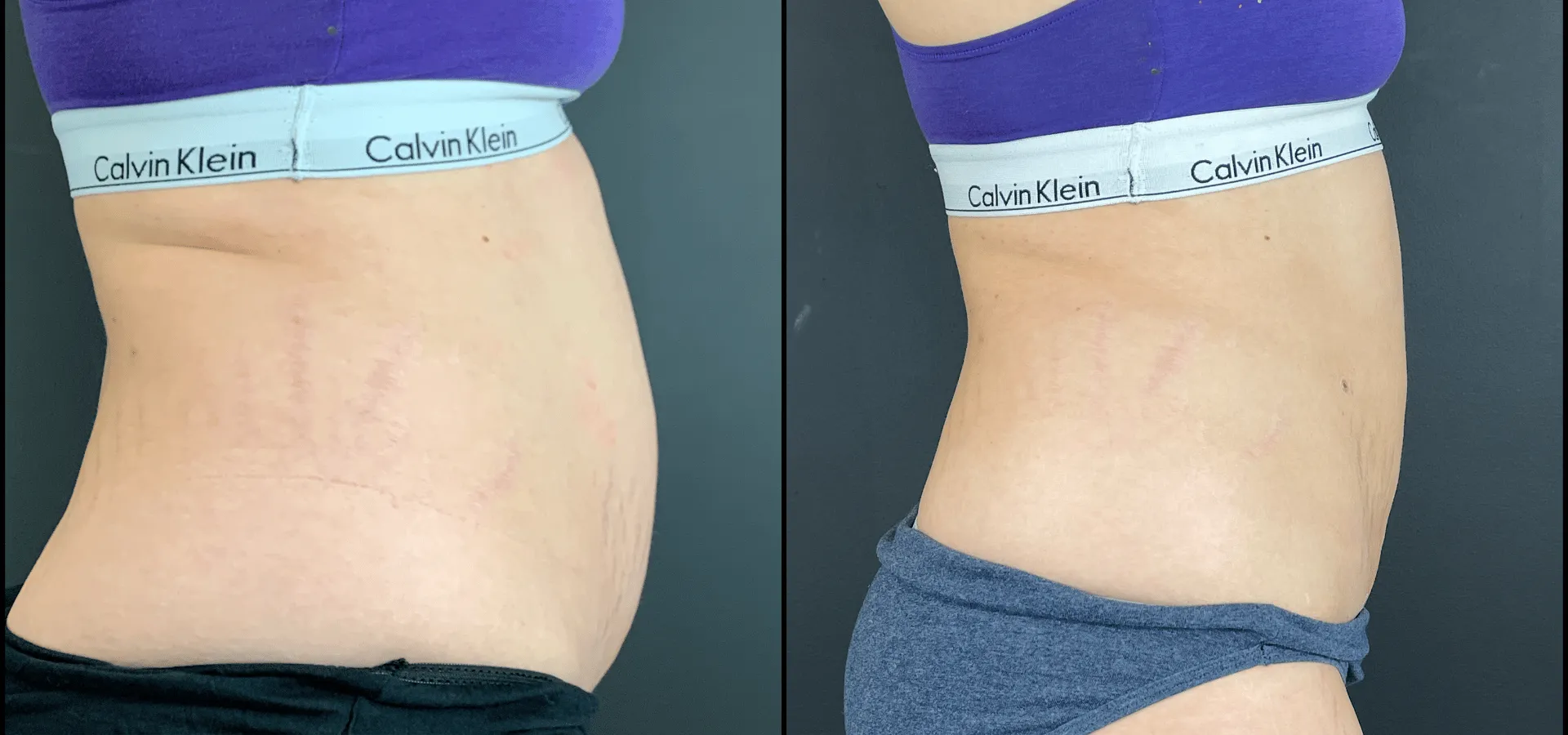 Before and after images of a woman that had the Smarlipo treatment done on abdomen